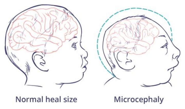 Can a baby with microcephaly be normal?