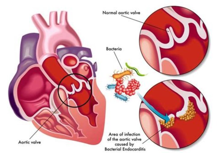 Can a TEE show endocarditis?