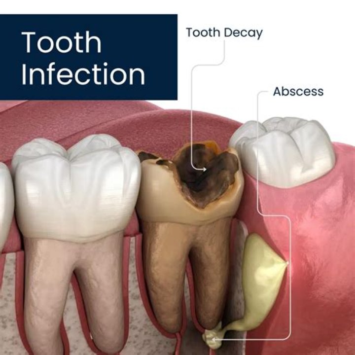 Can a tooth infection spread to your throat?
