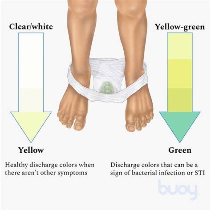 Can a yeast infection cause yellow green discharge?