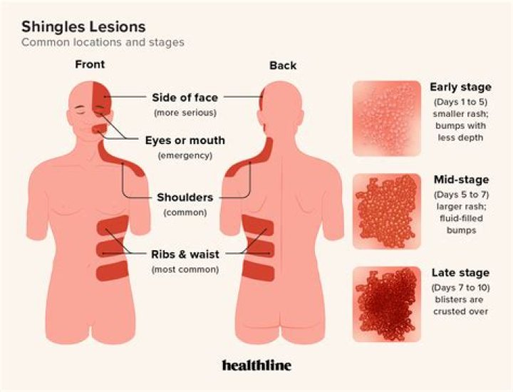 Can I give shingles to my elderly mother?