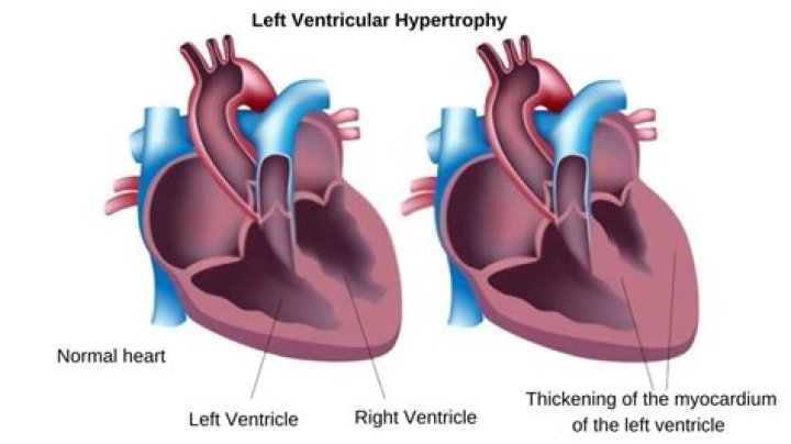 Can left ventricular hypertrophy be cured?