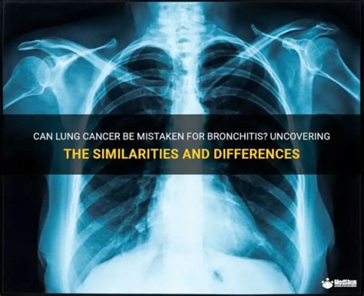 Can lung cancer be mistaken for bronchitis?