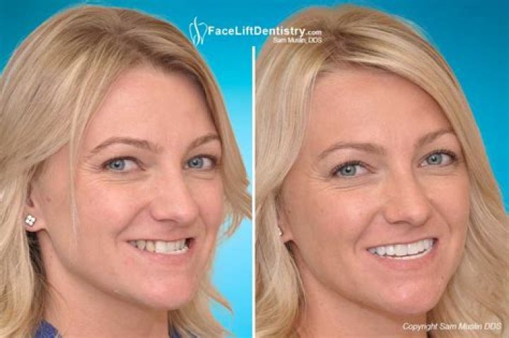 Can you get underbite surgery without braces?