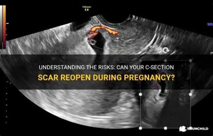 Can your C-section scar reopen?