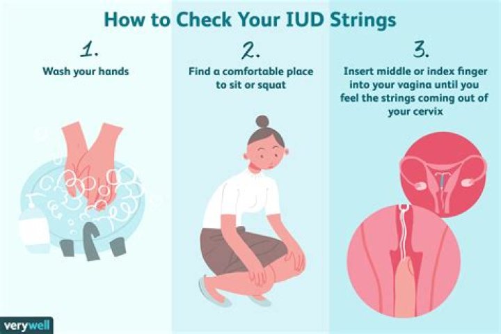 Do IUD strings change length?