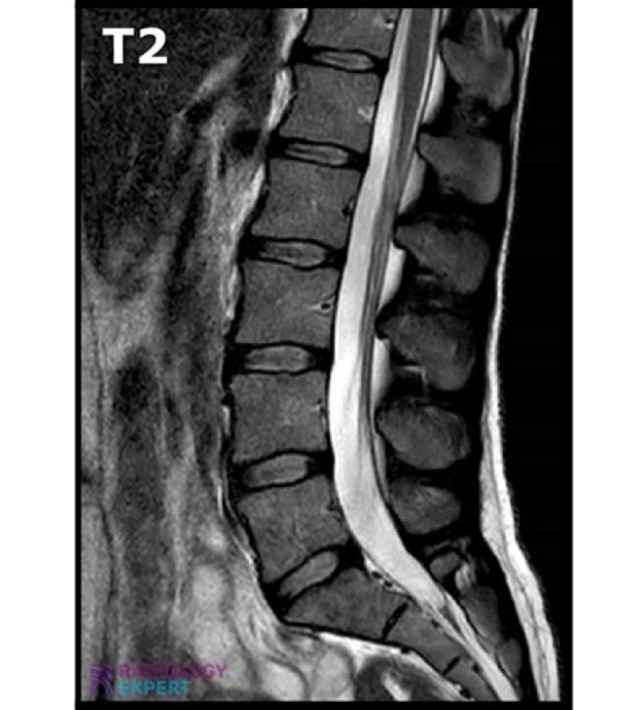 Do you need contrast for lumbar spine MRI?