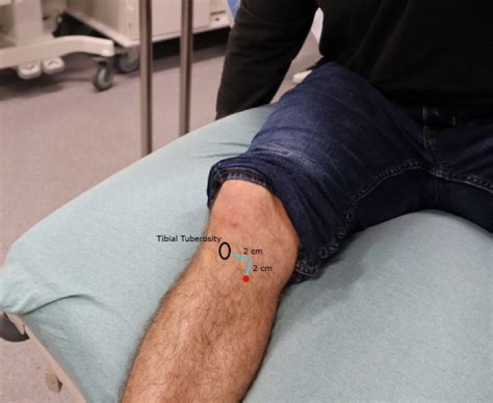 Does getting an IO hurt?