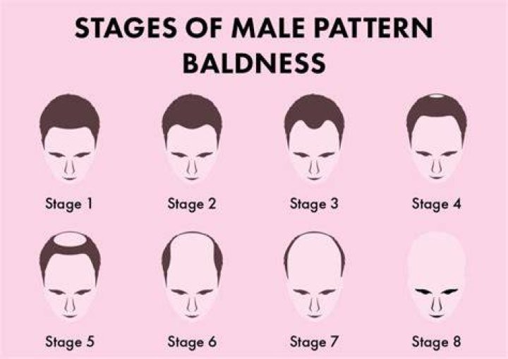 Does male pattern baldness mean low testosterone?