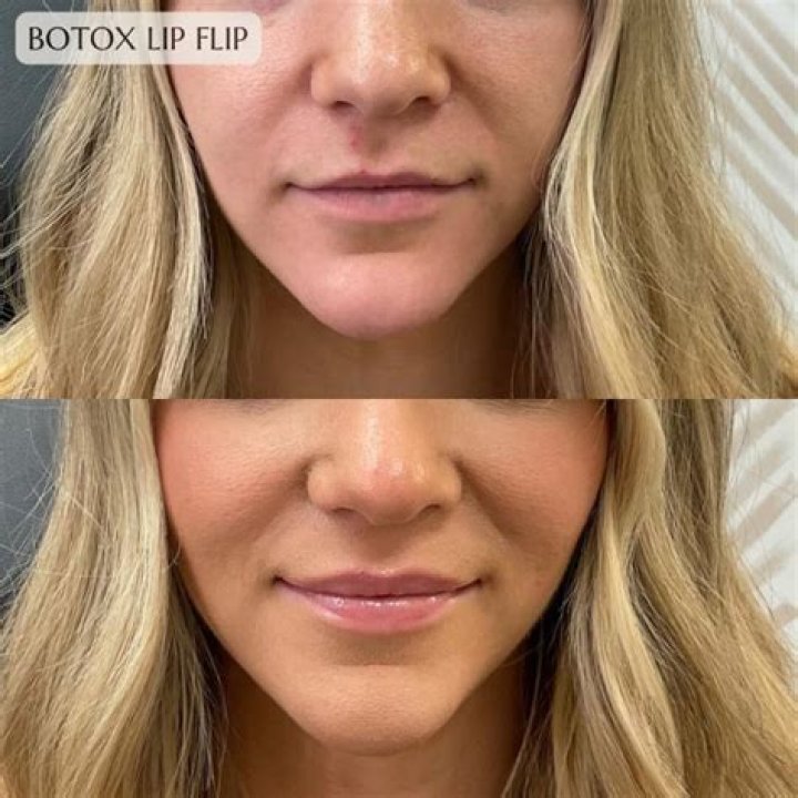 How can I make my lips bigger without lip fillers?