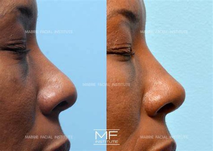 How can I make my nostril nose smaller without surgery?