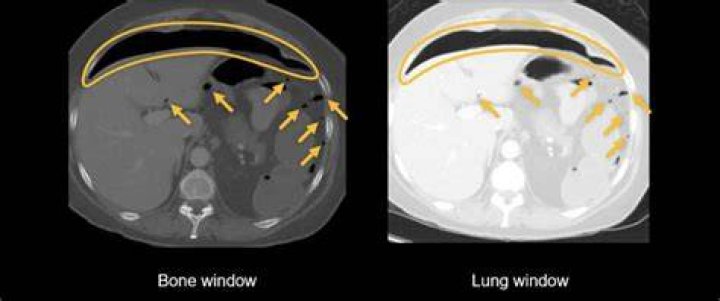 How do you detect intestinal perforation?