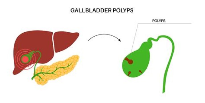 How do you dissolve a gallbladder polyp naturally?