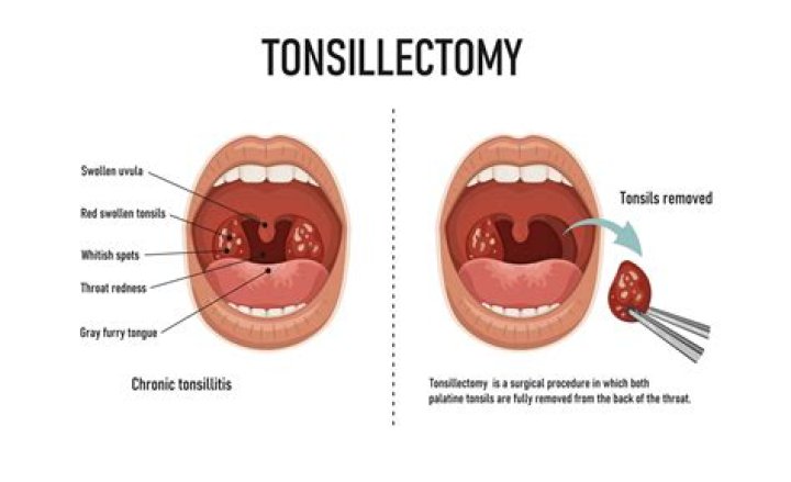 How do you get rid of one swollen tonsil?