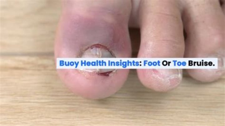How do you treat a deep bruise on your foot?