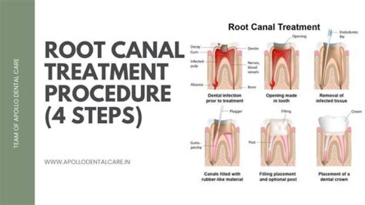 How do you treat a perforated root canal?