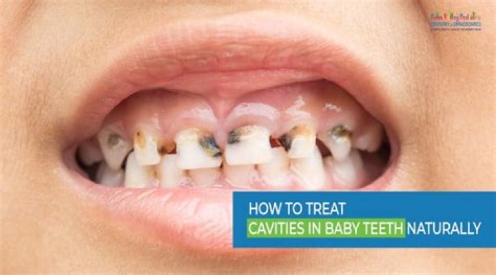 How do you treat cavities in babies molars?