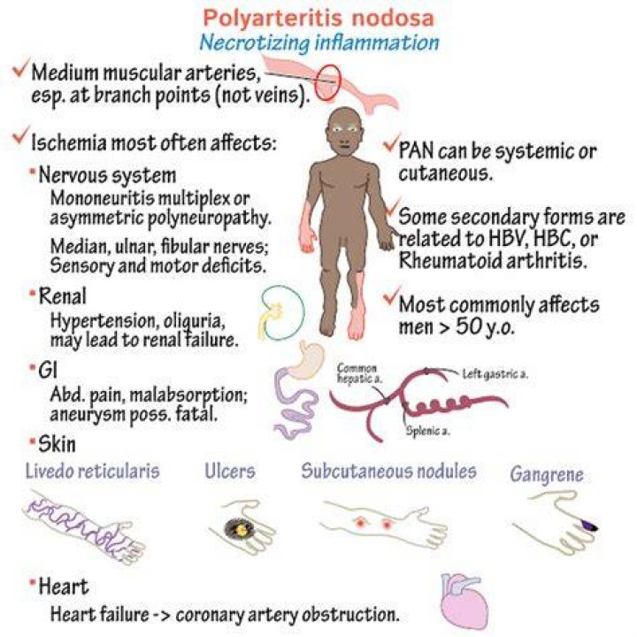 How long can you live with polyarteritis nodosa?