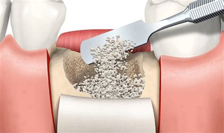 How long does it take a spinal bone graft to heal?