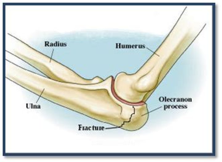 How long does it take for an olecranon fracture to heal?