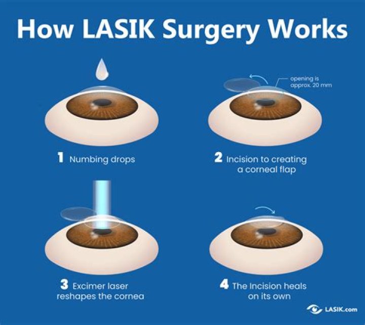 How long does it take for the flap to heal after laser eye surgery?