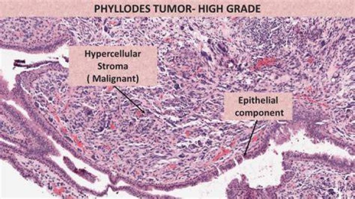 How serious is a phyllodes tumor?