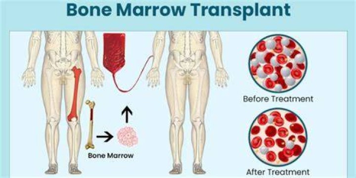 How was bone marrow transplant discovered?