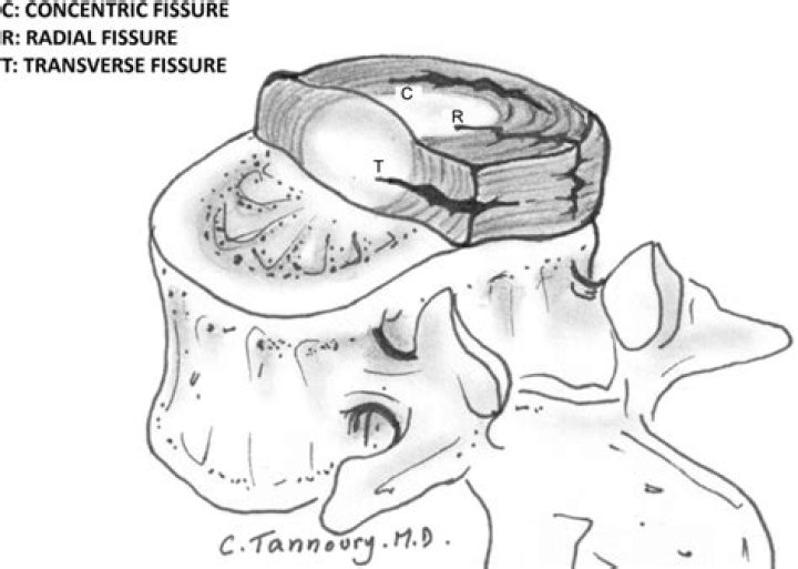 Is an annular fissure serious?