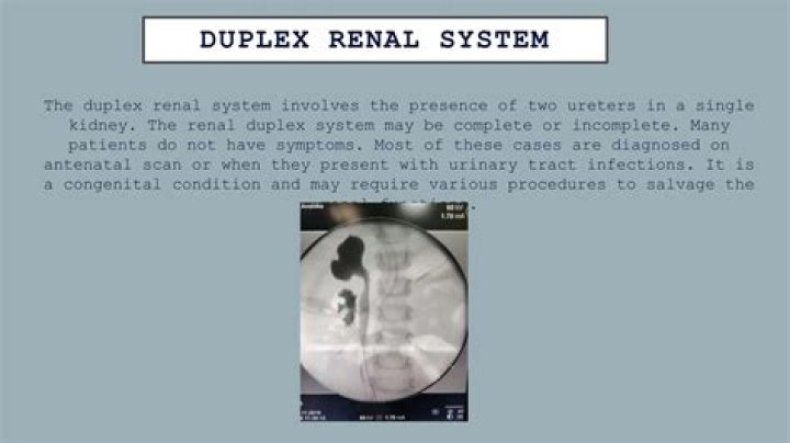 Is duplex kidney serious?