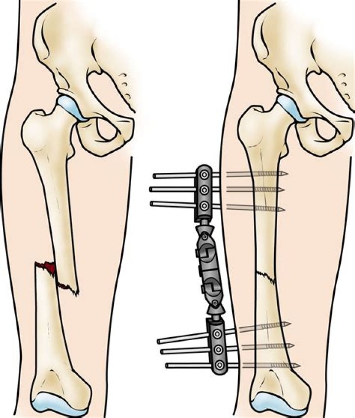 Is open reduction internal fixation a major surgery?