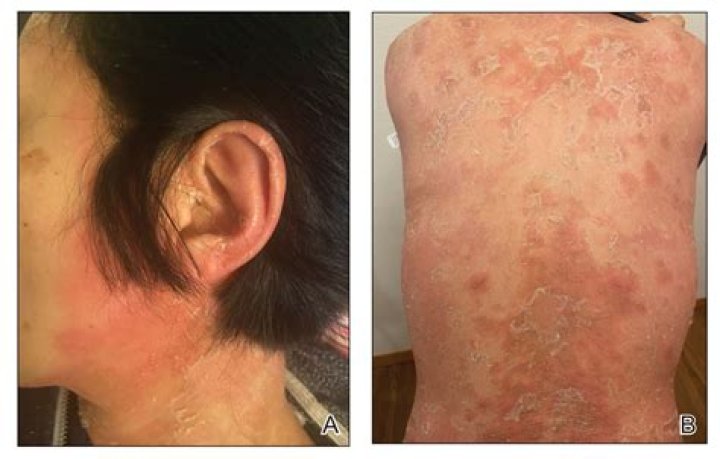 Is psoriasis a vitamin deficiency?