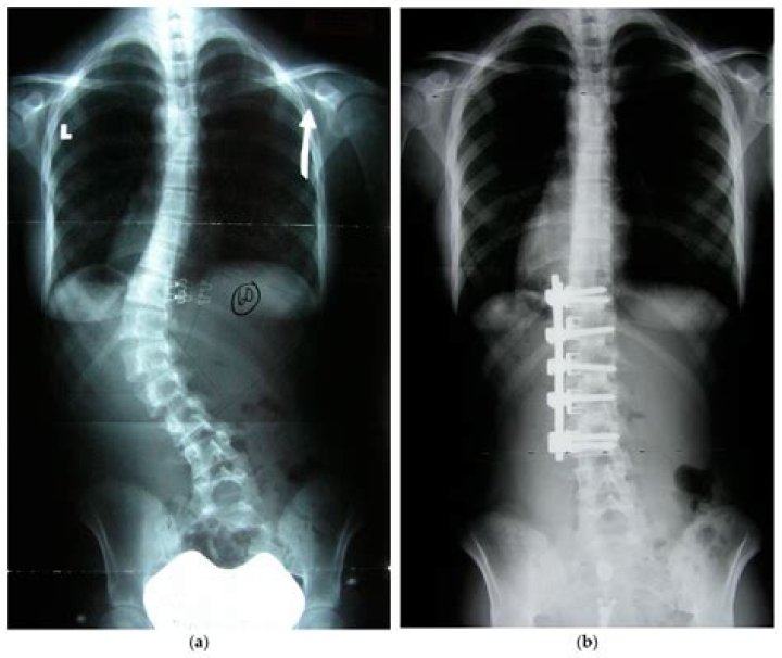 Is Spinal fusion for scoliosis worth it?
