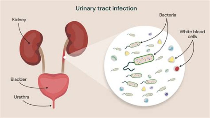 Is there yeast in UTI?