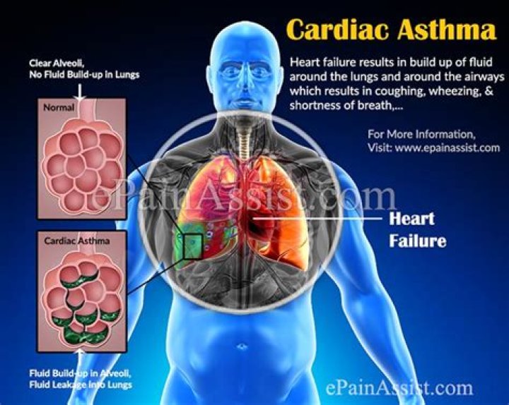 What causes cardiac asthma?