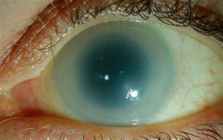 What causes Dermolipoma?