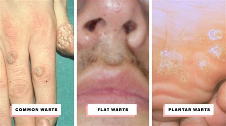 What causes warts on knuckles?