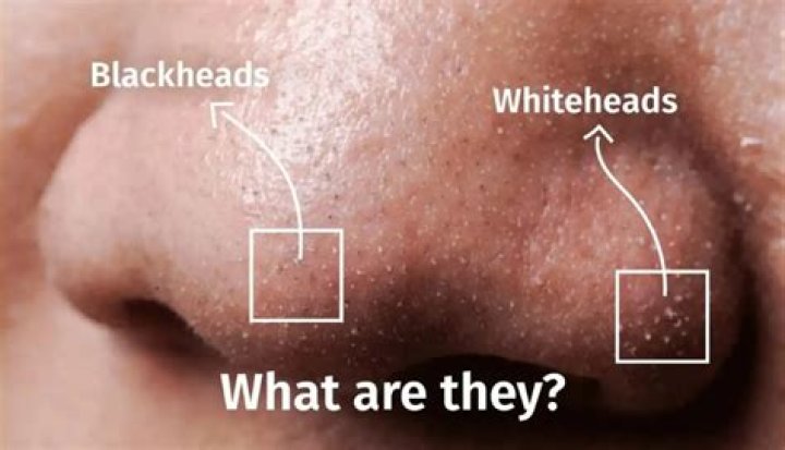 What causes whiteheads around mouth?