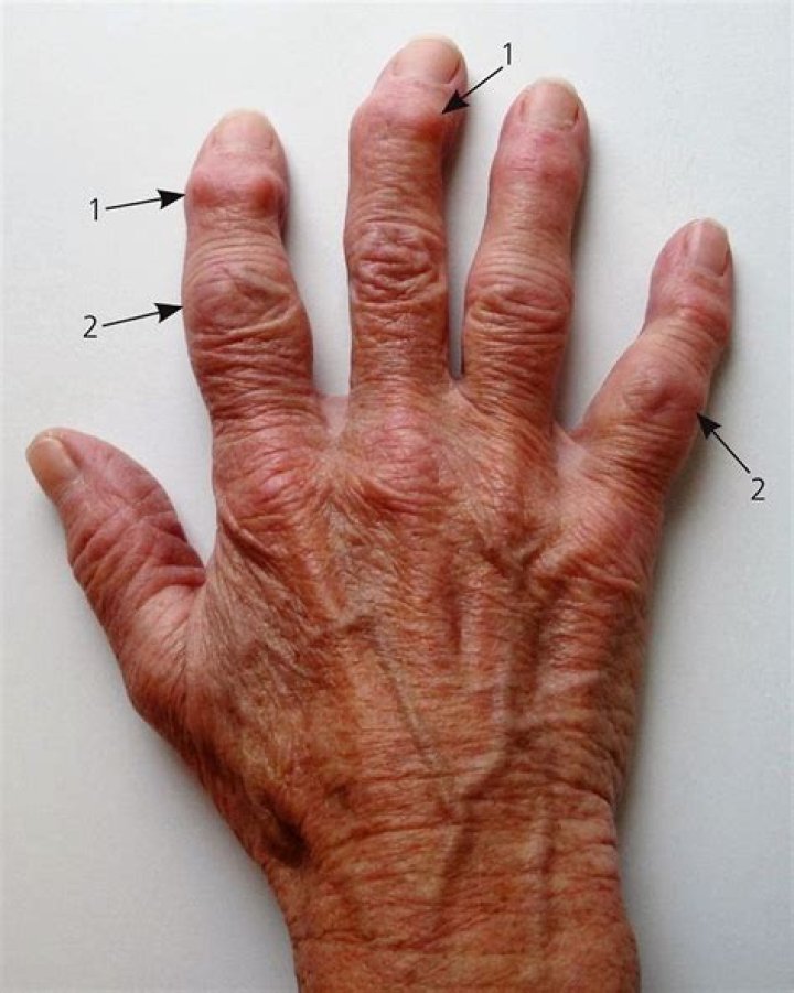 What do arthritis bumps look like?