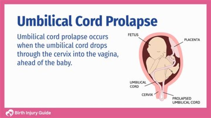 What do you do for a prolapsed cord?