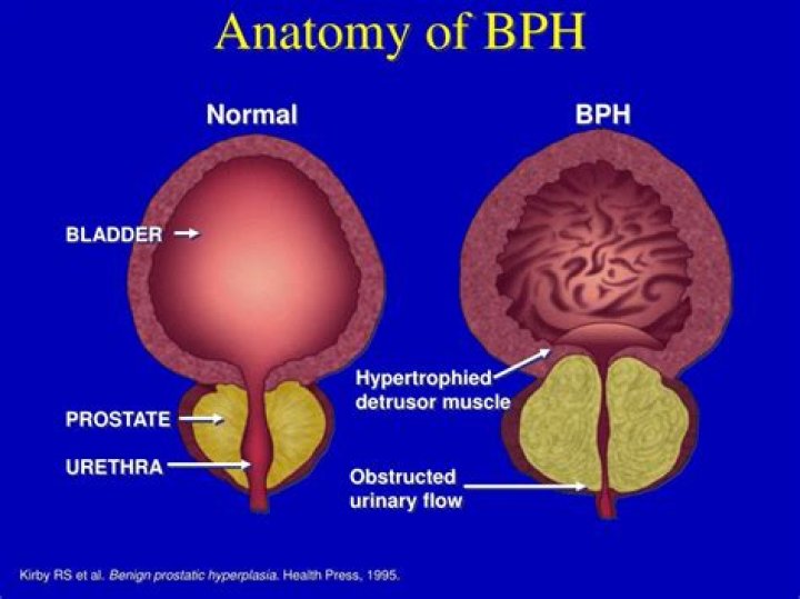 What does BPH stand for?