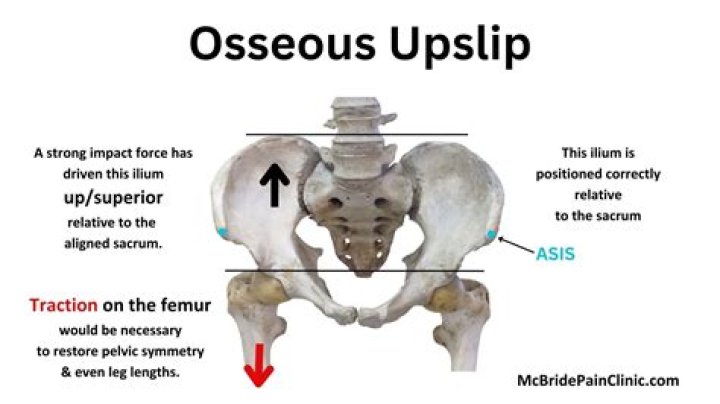 What does Upslip mean?