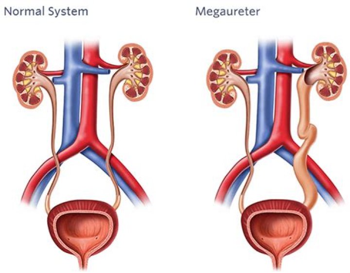 What is a obstructive Megaureter?
