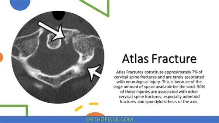 What is an atlas fracture?