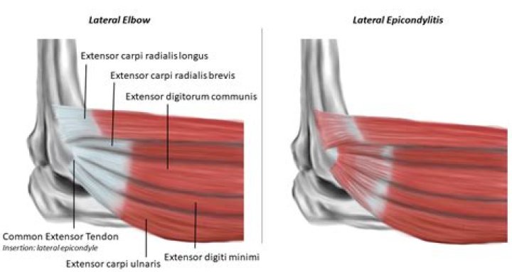 What is lateral epicondylitis right elbow?