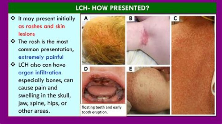 What is LCH compression?