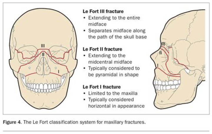 What is Maxillofacial fracture?