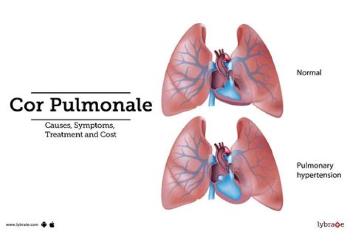 What is Pulmonale?