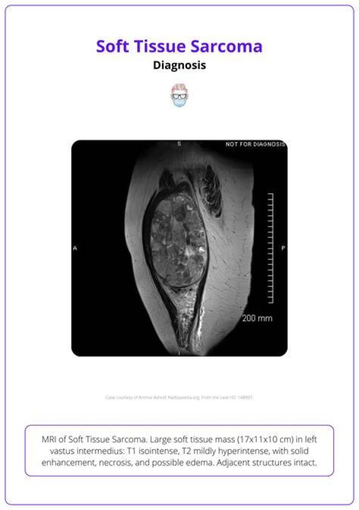 What is sarcoma of the breast?