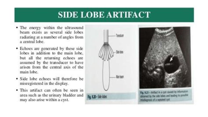 What is side lobe echo?