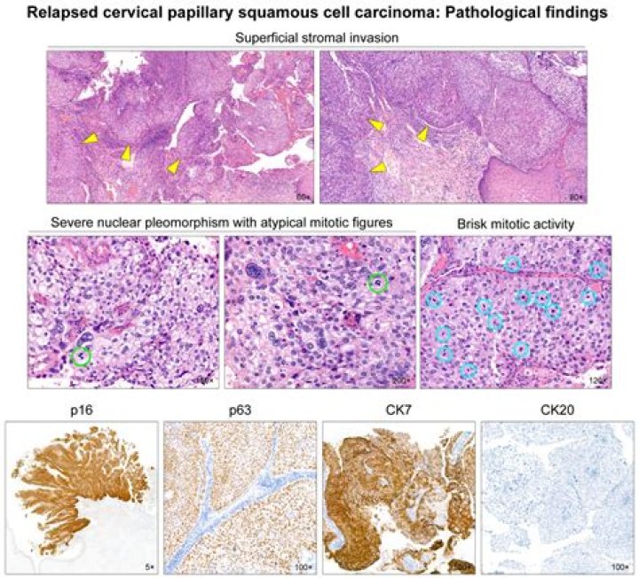 What is squamous cell carcinoma of cervix?